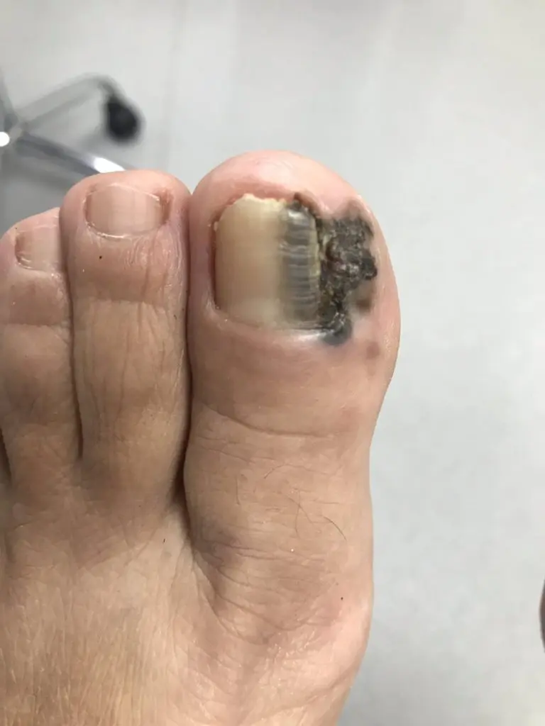 melanoma patch on big toe. Black splotch on skin and the right side of the nail. 