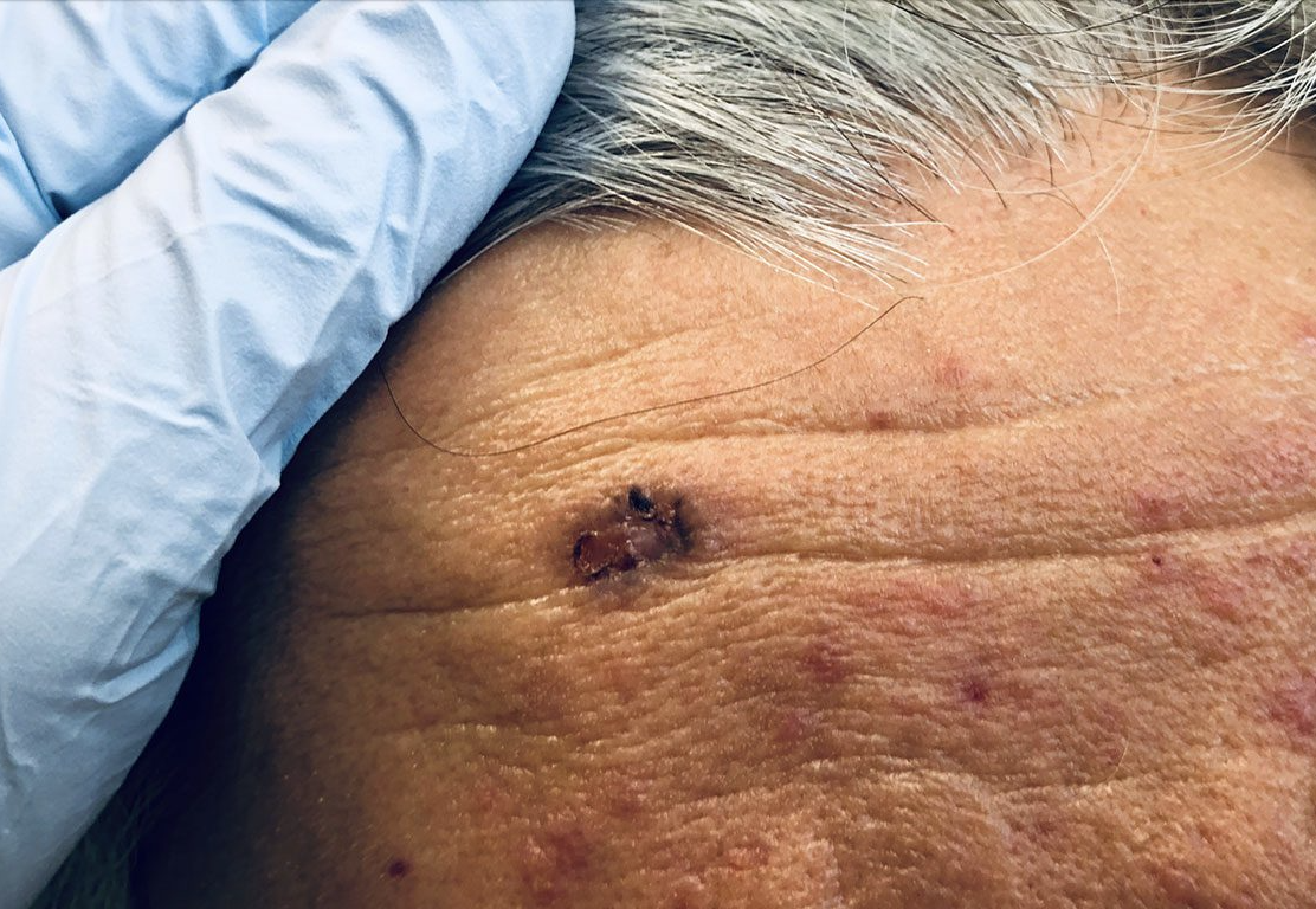 Image of a basal cell carcinoma skin mark on a patient's forehead being examined.