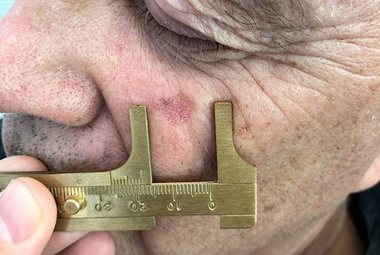 Picture of a patient's face with an actinic keratosis spot being measured by calipers.