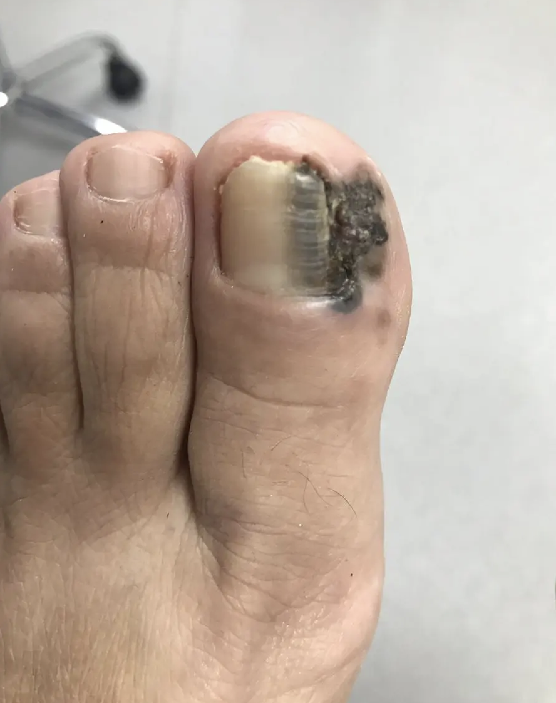 Image of a toe with a black discolouration on the right side of the nail and part of the toe, diagnosed as melanoma