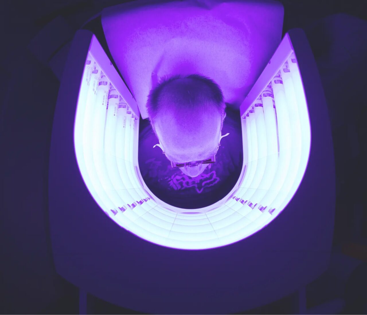 An overhead shot of a person inside a photodynamic therapy machine with protective glasses on. The picture is tinted purple. 