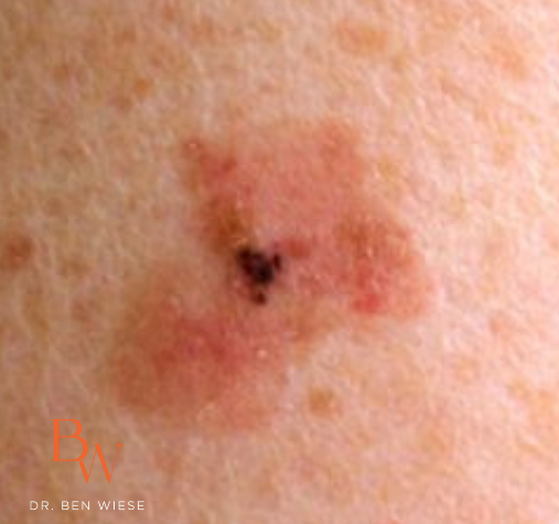 Superficial spreading melanoma on skin.