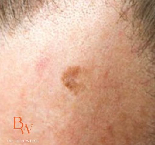 Up-close image of lentigo maligna melanoma. 