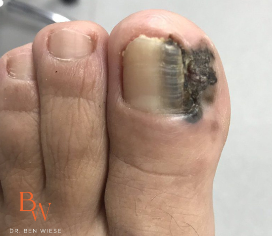 melanoma patch on big toe. Black splotch on skin and the right side of the nail. 