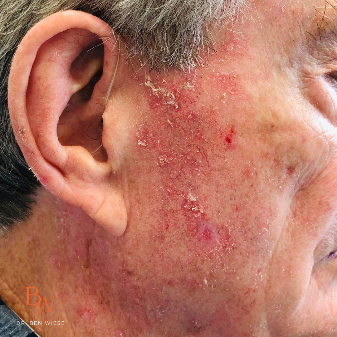 Up close image of actinic keratosis.