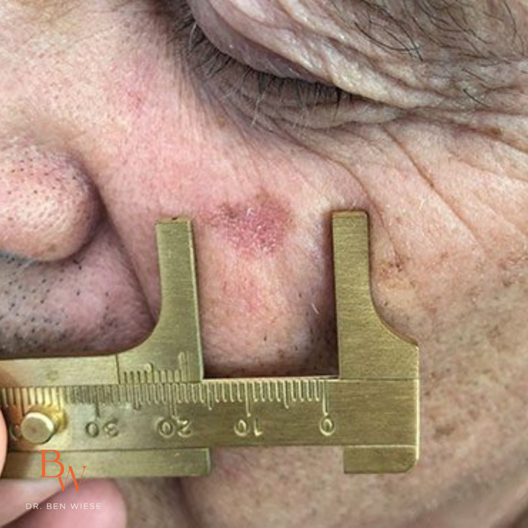 Up close image of actinic keratosis with a measuring tool.