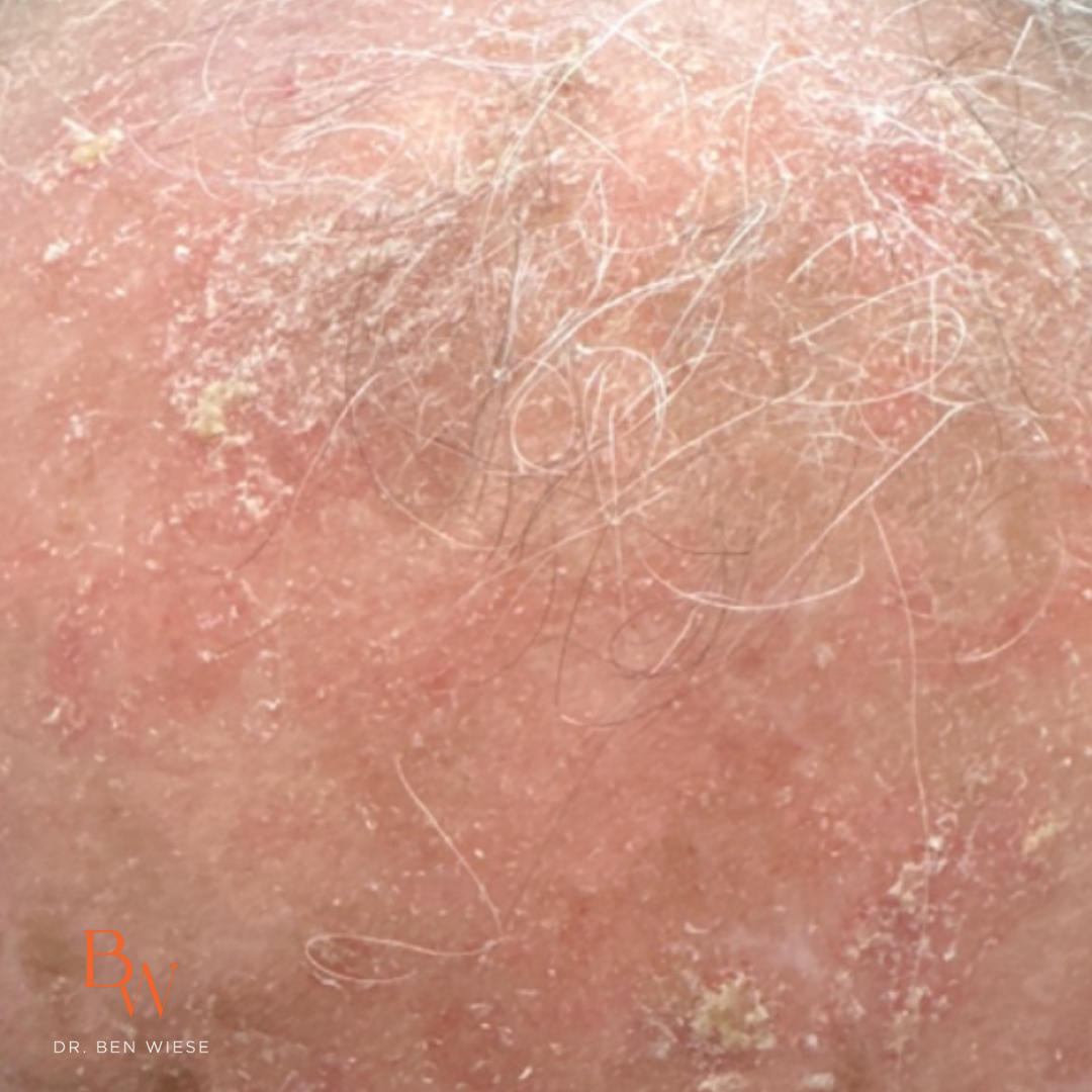 Up close image of extensive actinic keratosis.