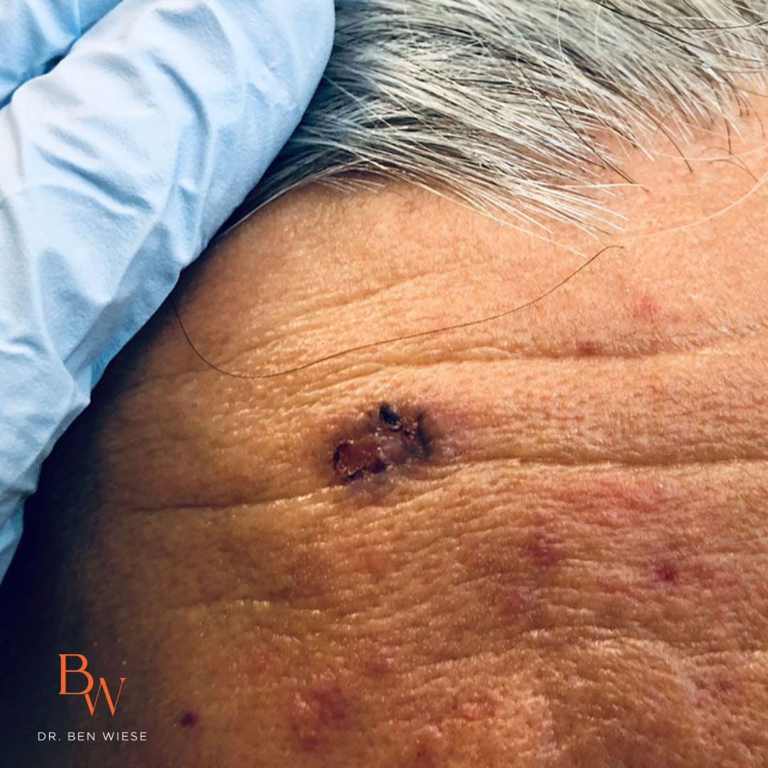 Up close image of nodular and infiltrative basal cell carcinoma treatment.