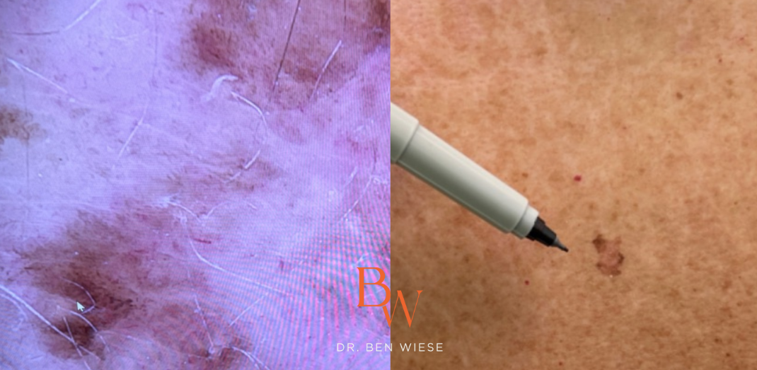 Two images in a grid of early evolving melanoma in situ. on the right it's being pointed out by a pen.