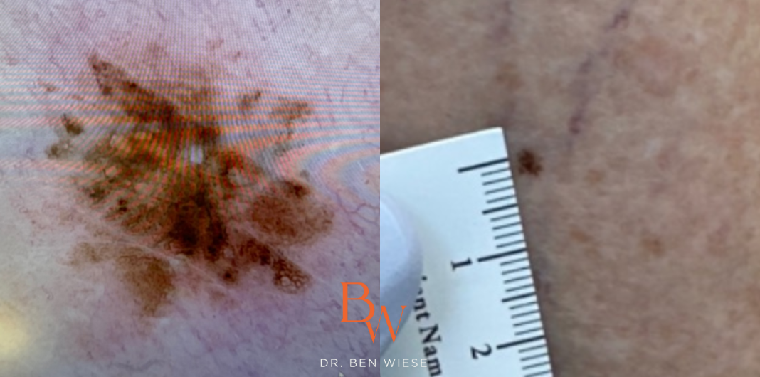 Two images in a grid of early evolving melanoma in situ. On the right it's being measured with a ruler.