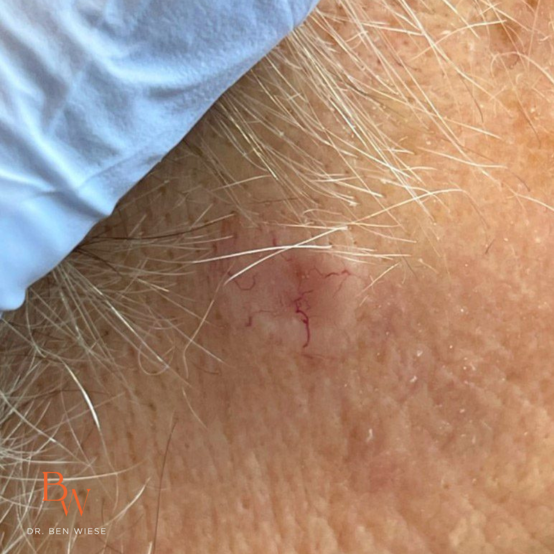 Up close image of nodular and infiltrative basal cell carcinoma with a hairline and glove in upper left corner.