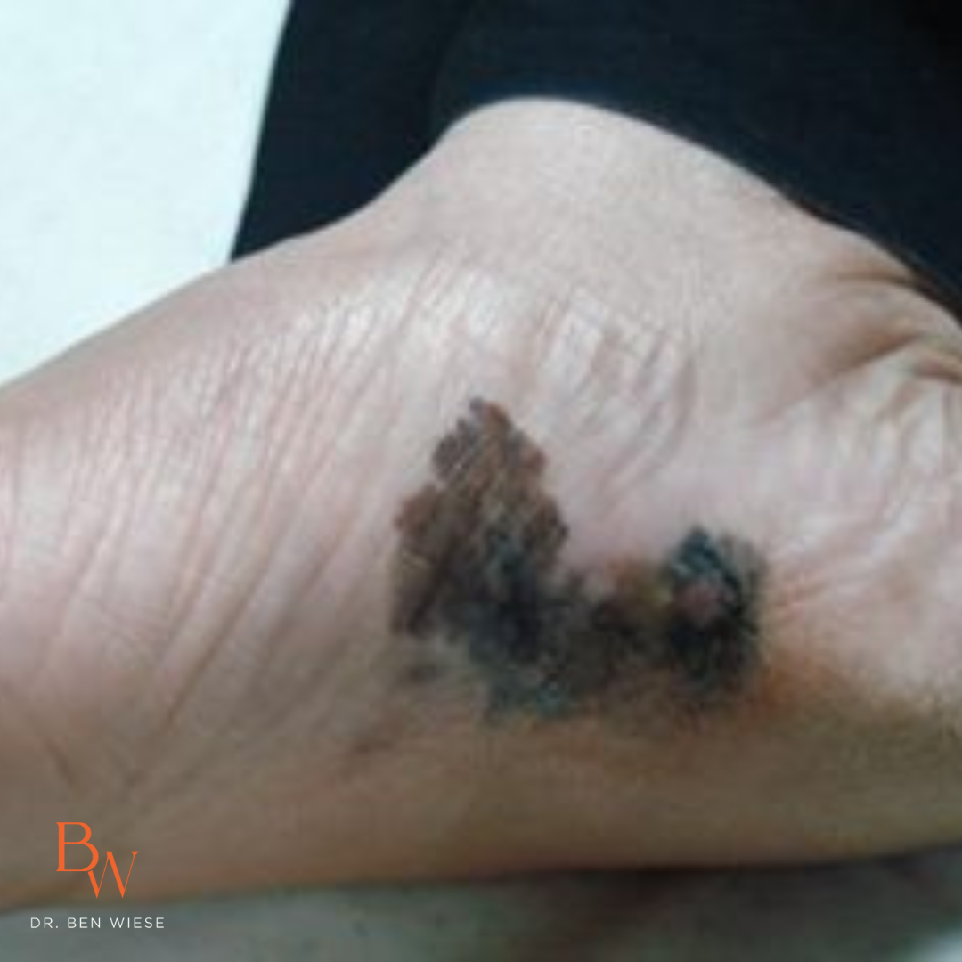 image of melanoma acral lentiginous on foot. 