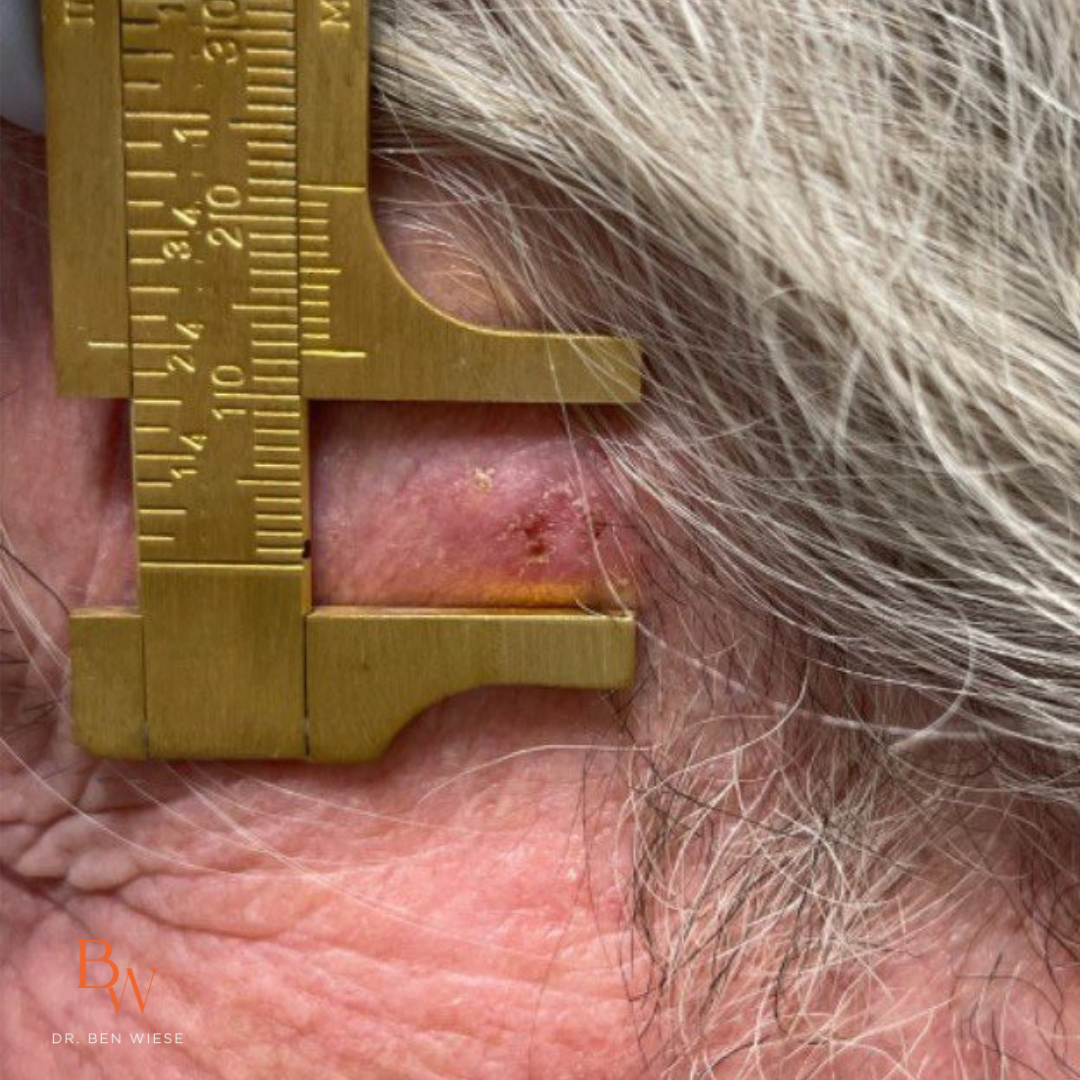 Up close image of squamous cell carcinoma being measured by a set of gold calipers. 