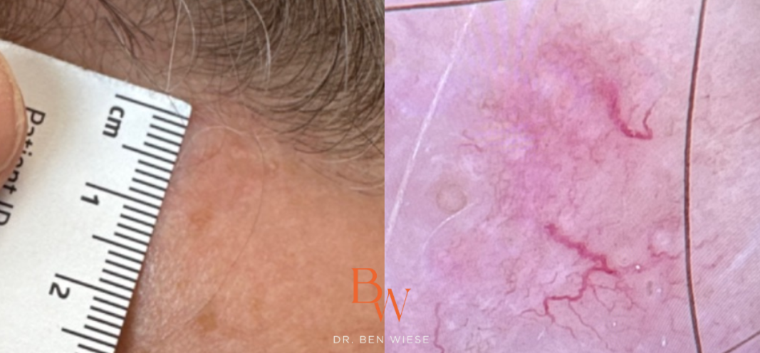 Two images in a grid of up-close images of infiltrative basal cell carcinoma.