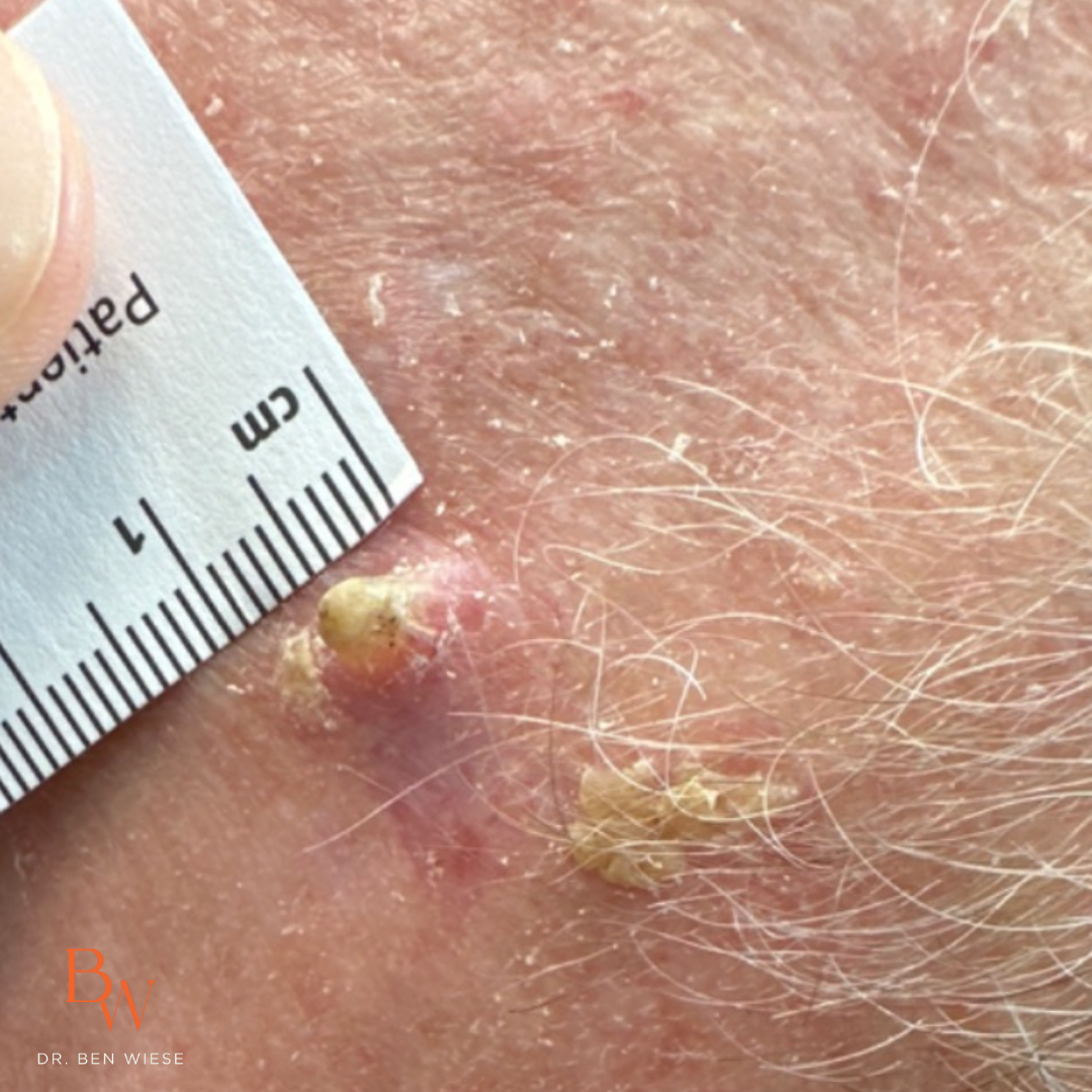 Up close image of squamous cell carcinoma being measured by a ruler. 