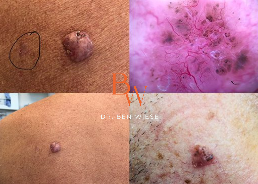 Four images in a grid of up-close images of basal cell carcinoma.