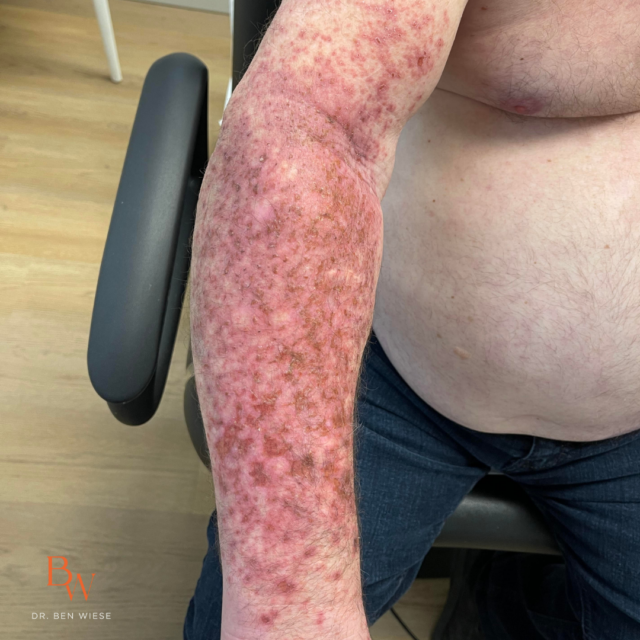 efudex treatment for actinic keratosis