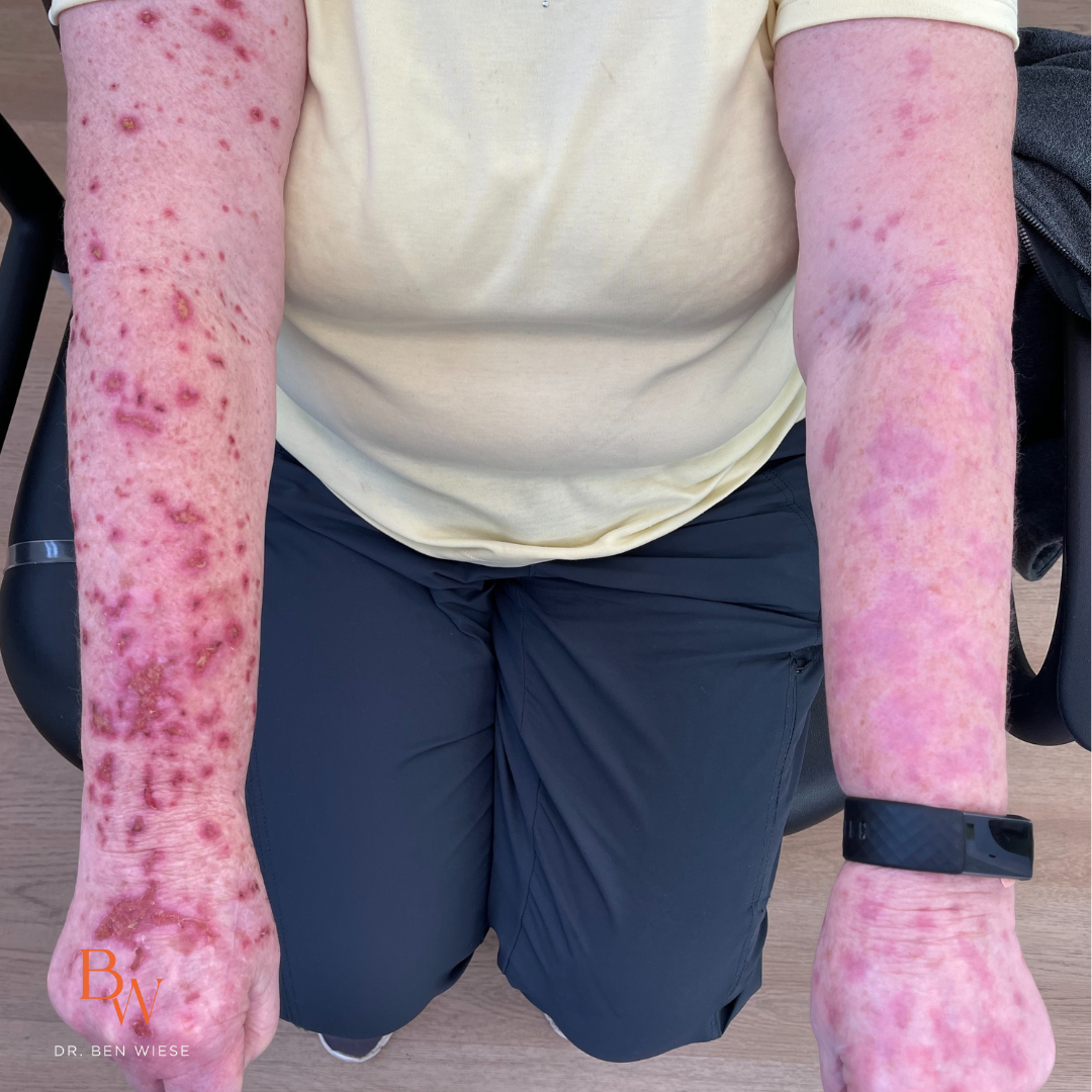 Patient's arms after an Efudex Treatment for Actinic Keratosis. Red blotches up and down arms.