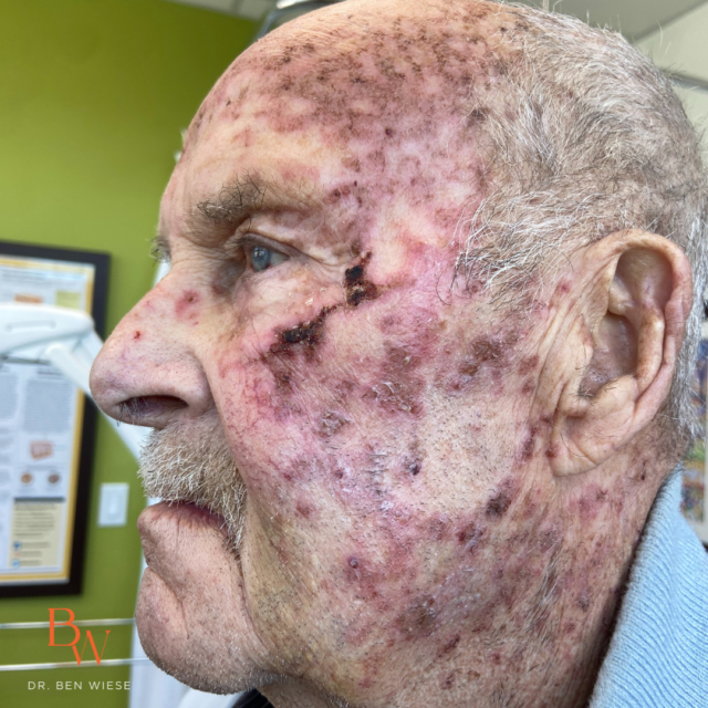 Image of a patient's face after Efudex Treatment. Older gentleman with mottled red, pink and brown splotches all over the left side of his face. 