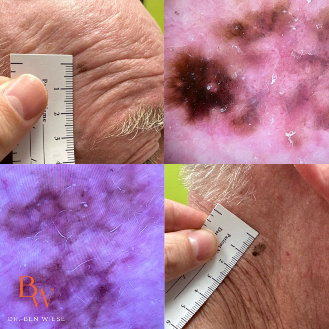 Grid of four images of different levels of melanoma.