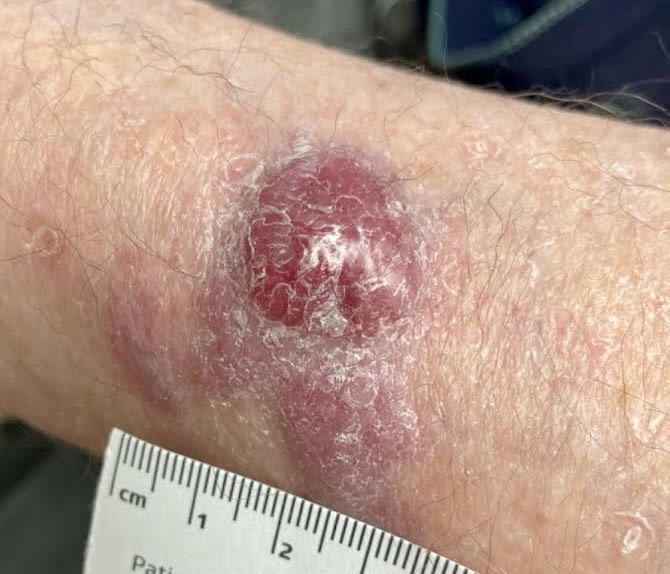 Merkel cell carcinoma on skin