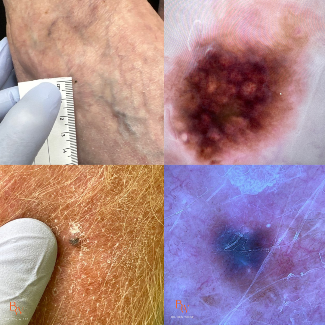 Grid of four images of different levels of melanoma. 