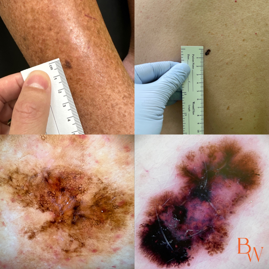 a grid of four images of melanoma spots with a measuring tool to show size